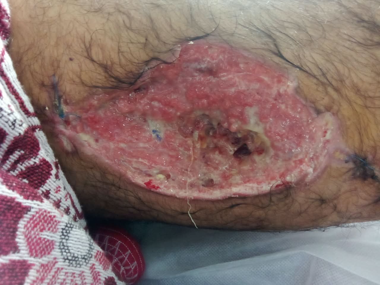 Close-up medical photograph of an injury